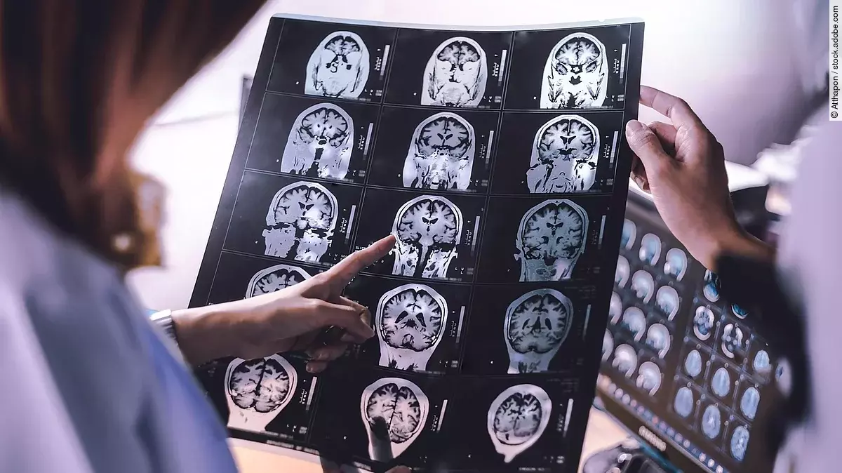 MRT-Bild des Gehirns eines an Demenz erkrankten Patienten