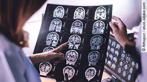 Bildgebung Magnetresonanztomografie MRT-Bild des Gehirns eines an Demenz erkrankten Patienten