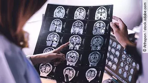 MRT-Bild des Gehirns eines an Demenz erkrankten Patienten