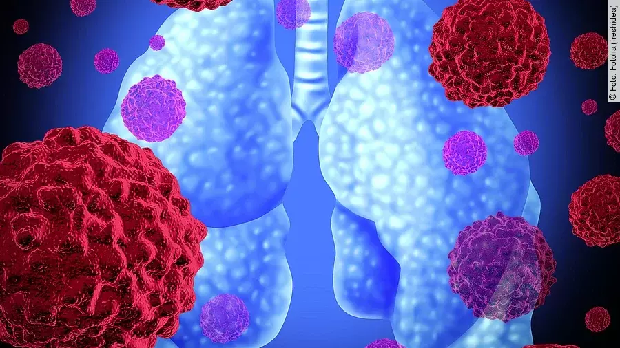 Lungenkrebs