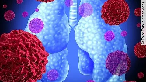 Lungenkrebs Lungenkrebs