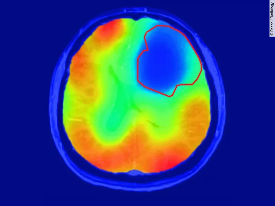 Neues Verfahren in der Bildgebung von Daniel Peach zeigt Tumor an