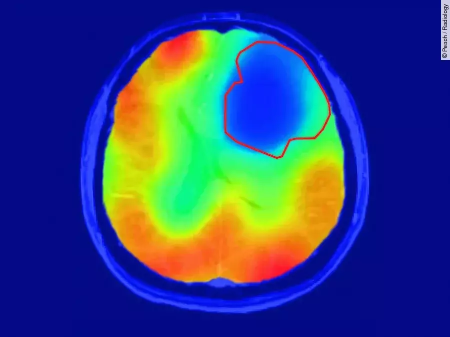 Neues Verfahren in der Bildgebung von Daniel Peach zeigt Tumor an