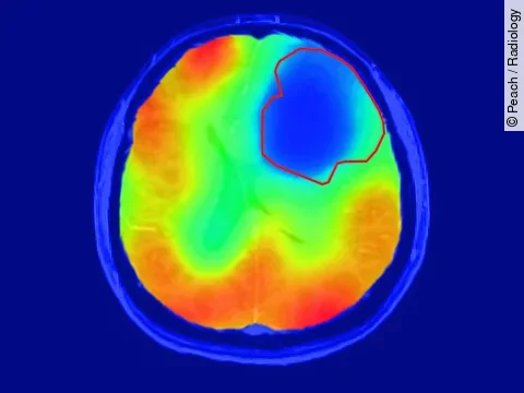 Neues Verfahren in der Bildgebung von Daniel Peach zeigt Tumor an