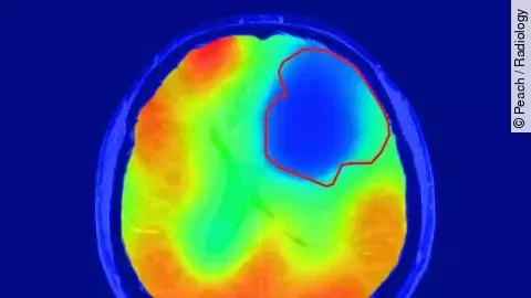 Neues Verfahren in der Bildgebung von Daniel Peach zeigt Tumor an