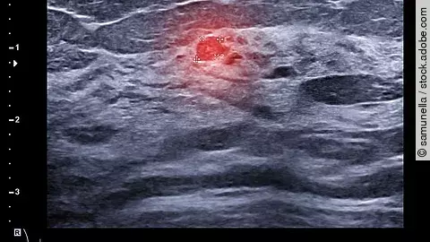 Ultraschall Brustkrebsdiagnostik