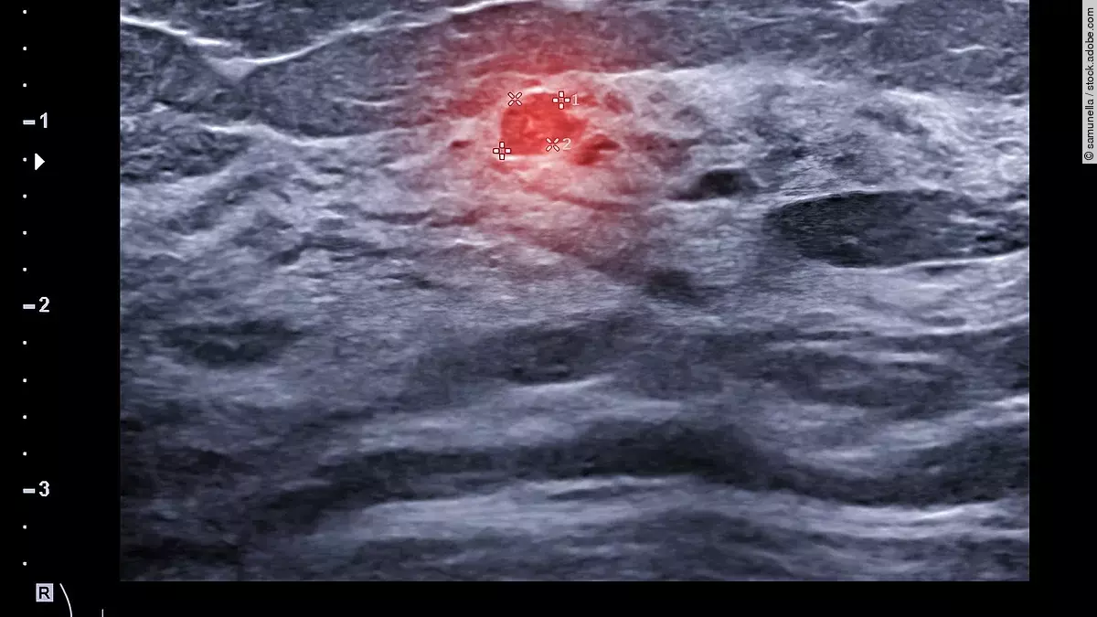 Ultraschall Brustkrebsdiagnostik