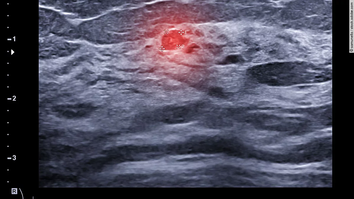 Ultraschall Brustkrebsdiagnostik