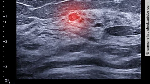 Ultraschall Brustkrebsdiagnostik Ultraschall Brustkrebsdiagnostik
